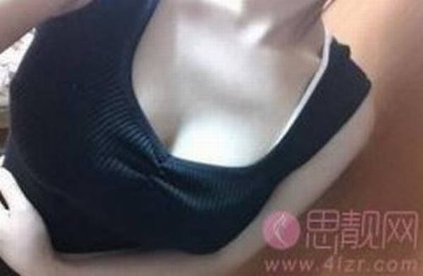 抽脂丰胸真的好吗？
