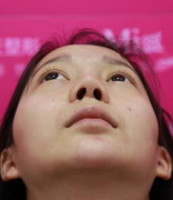 重庆硅胶鼻综合术后案例分享