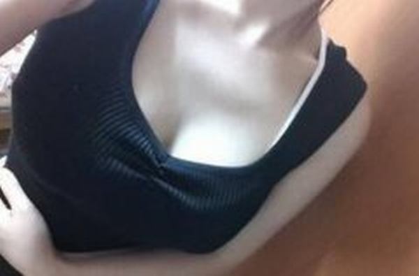 自体脂肪隆胸手术有什么注意事项