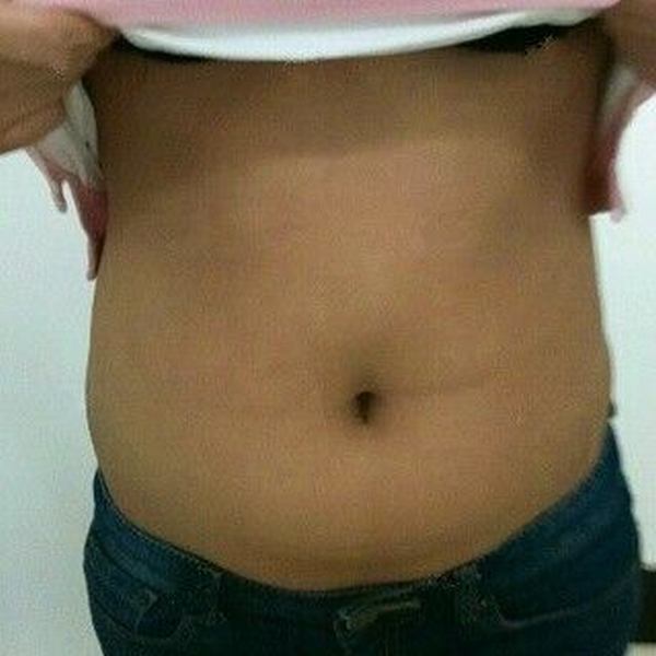 上海水动力吸脂变小蛮腰