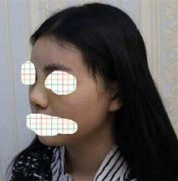 上海鼻综合术后变美女案例分享
