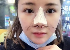 做了鼻综合 丑小鸭也可以变白天鹅