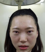 八大处郭鑫去眼袋怎么样？案例分享
