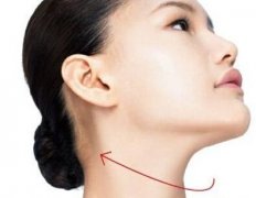 咸阳面部吸脂去双下巴多少钱