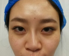 上海歪鼻矫正术后案例分享