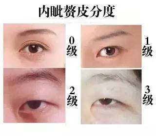 开眼角需要多少钱