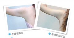 做完手臂减肥注意什么