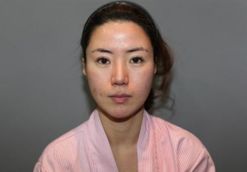 额头填充术费用贵不贵