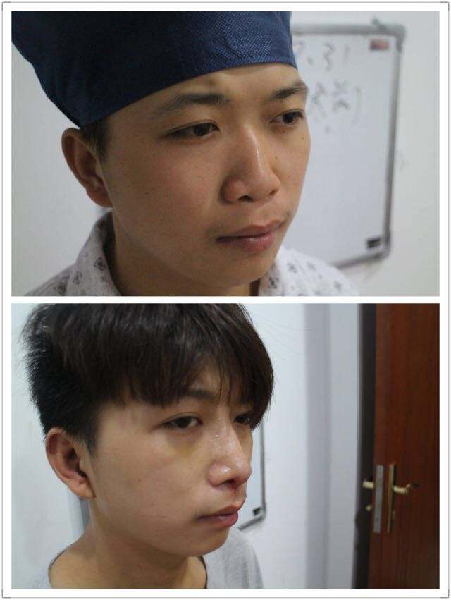 做歪鼻矫正术方法有哪些
