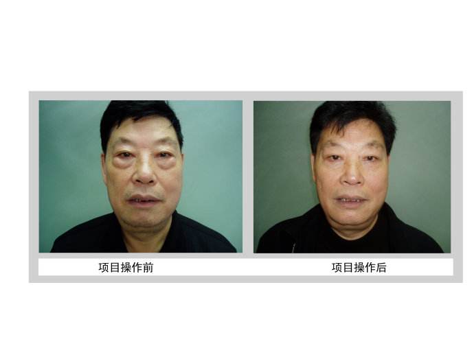 微创去眼袋恢复要多久