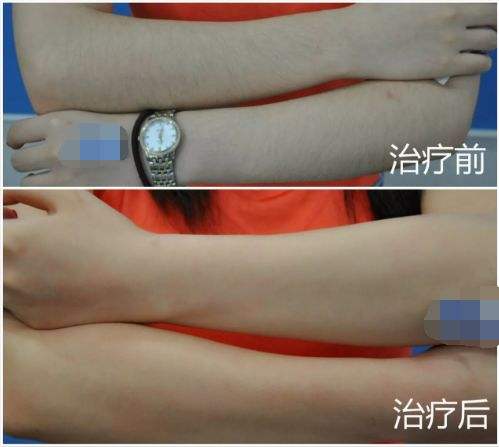 手臂脱毛的方法？
