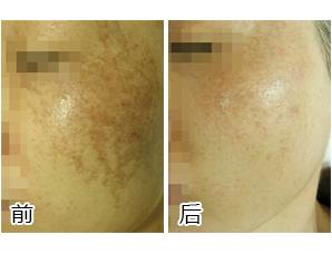 黄褐斑怎么治疗最有效？