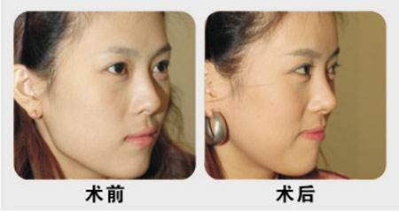 上海九院做下颌角磨骨术价格