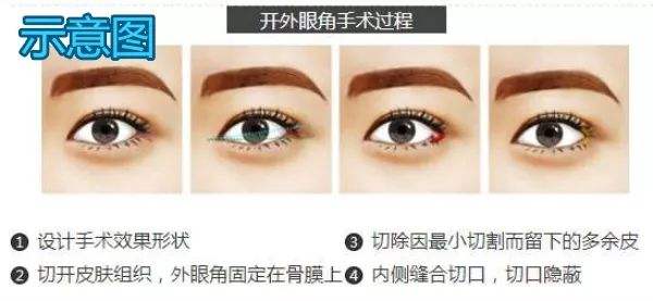 开内眼角的危害