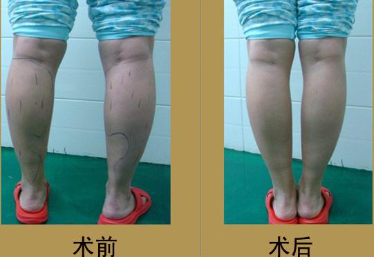 小腿吸脂减肥价格？