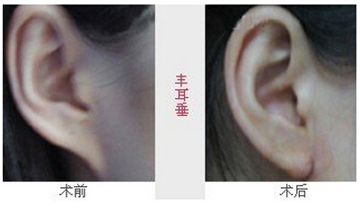 玻尿酸丰耳垂需要几次?