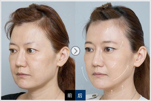 光电美容项目是指什么?