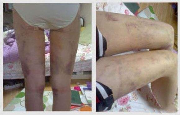 大腿吸脂痛吗?