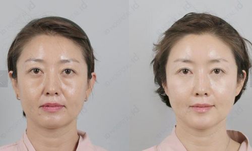 北京电波拉皮价格需要多少？