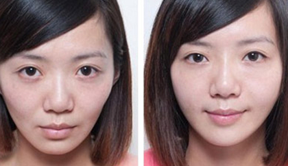 丰面颊手术要多少钱？