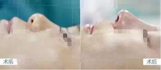 注射隆鼻有什么危害?