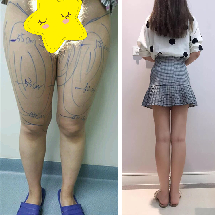 大腿吸脂效果到底如何？
