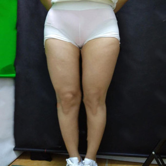 大腿吸脂修复多少钱？