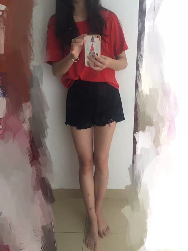 大腿吸脂修复痛不痛？