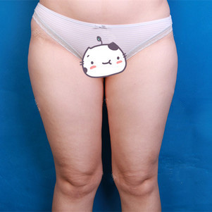 大腿吸脂多久可以见效?
