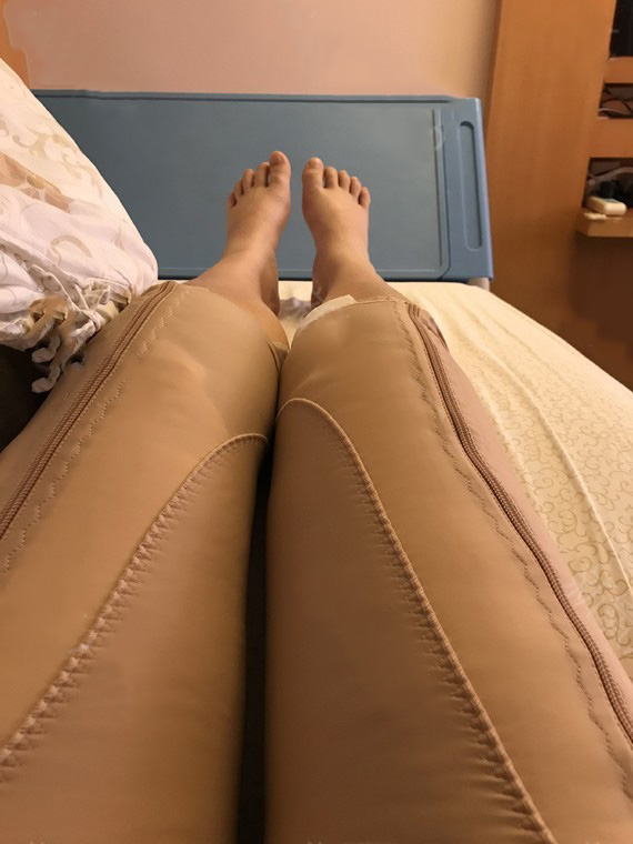 大腿吸脂多久可以见效?