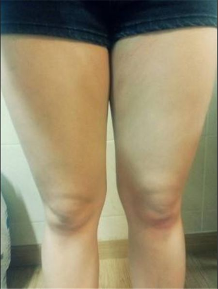 成都艾米丽程洪涛大腿吸脂案例