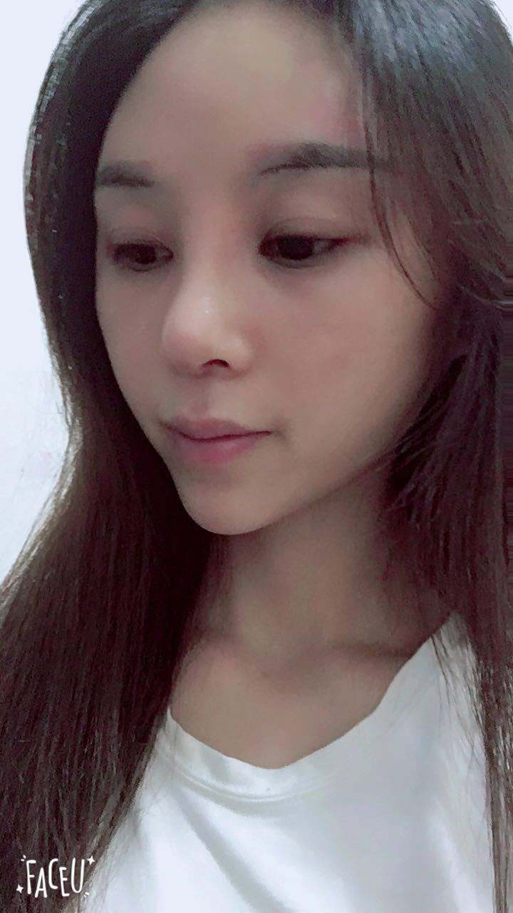 隆鼻后鼻头大怎么办?