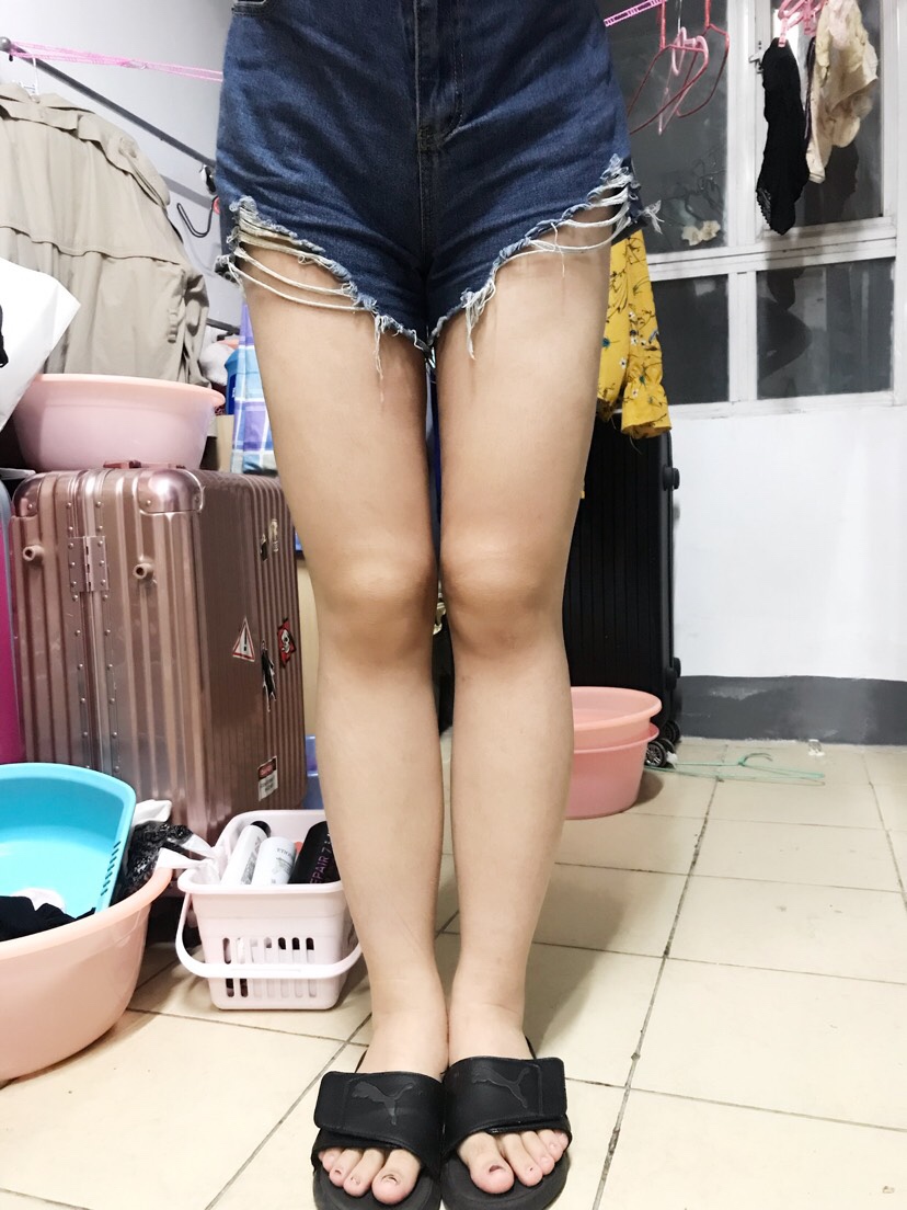 吸脂会反弹吗？