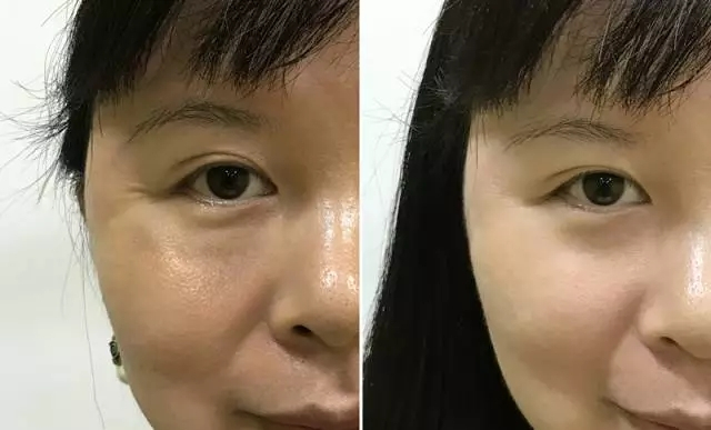 水光针效果图前后对比？