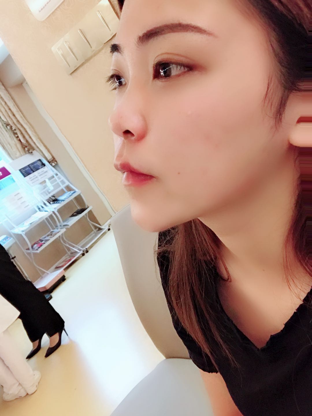 九院徽晓洁医生隆鼻案例