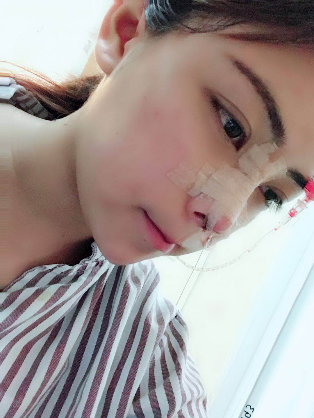 九院徽晓洁医生隆鼻案例