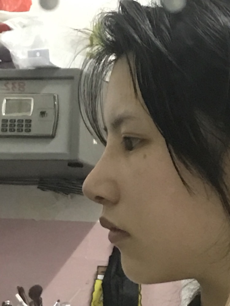 八大处李占强隆鼻怎么样?案例