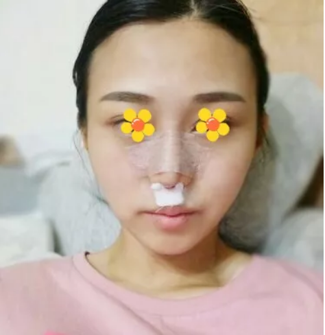 成都军大钟正强隆鼻怎么样？案例