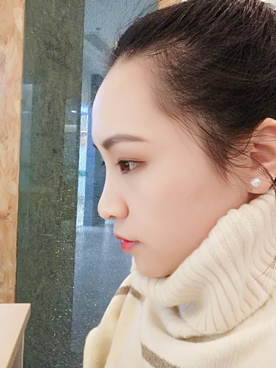上海华美整形价格表,附硅胶隆鼻案例展示效果