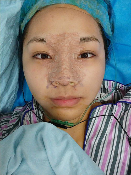 上海华美整形价格表,附硅胶隆鼻案例展示效果