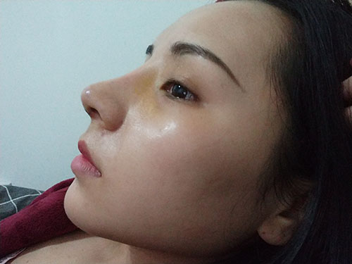 上海华美整形价格表,附硅胶隆鼻案例展示效果