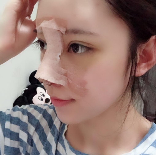 八大处隆鼻谁做的好,附隆鼻案例