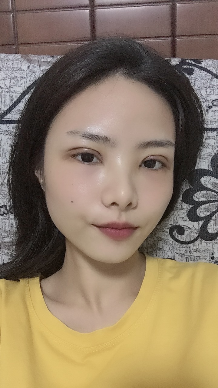 成都八大处于晓波双眼皮案例