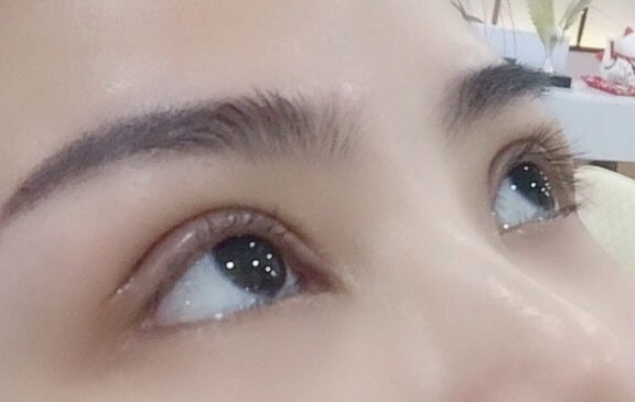成都八大处于晓波双眼皮案例