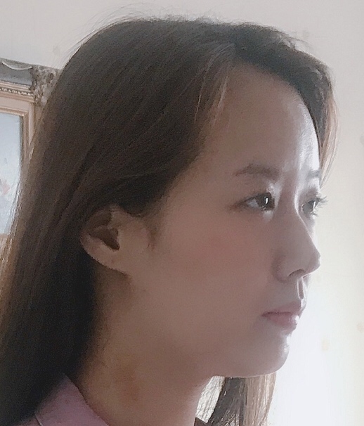 西安西京宋宝强双眼皮案例