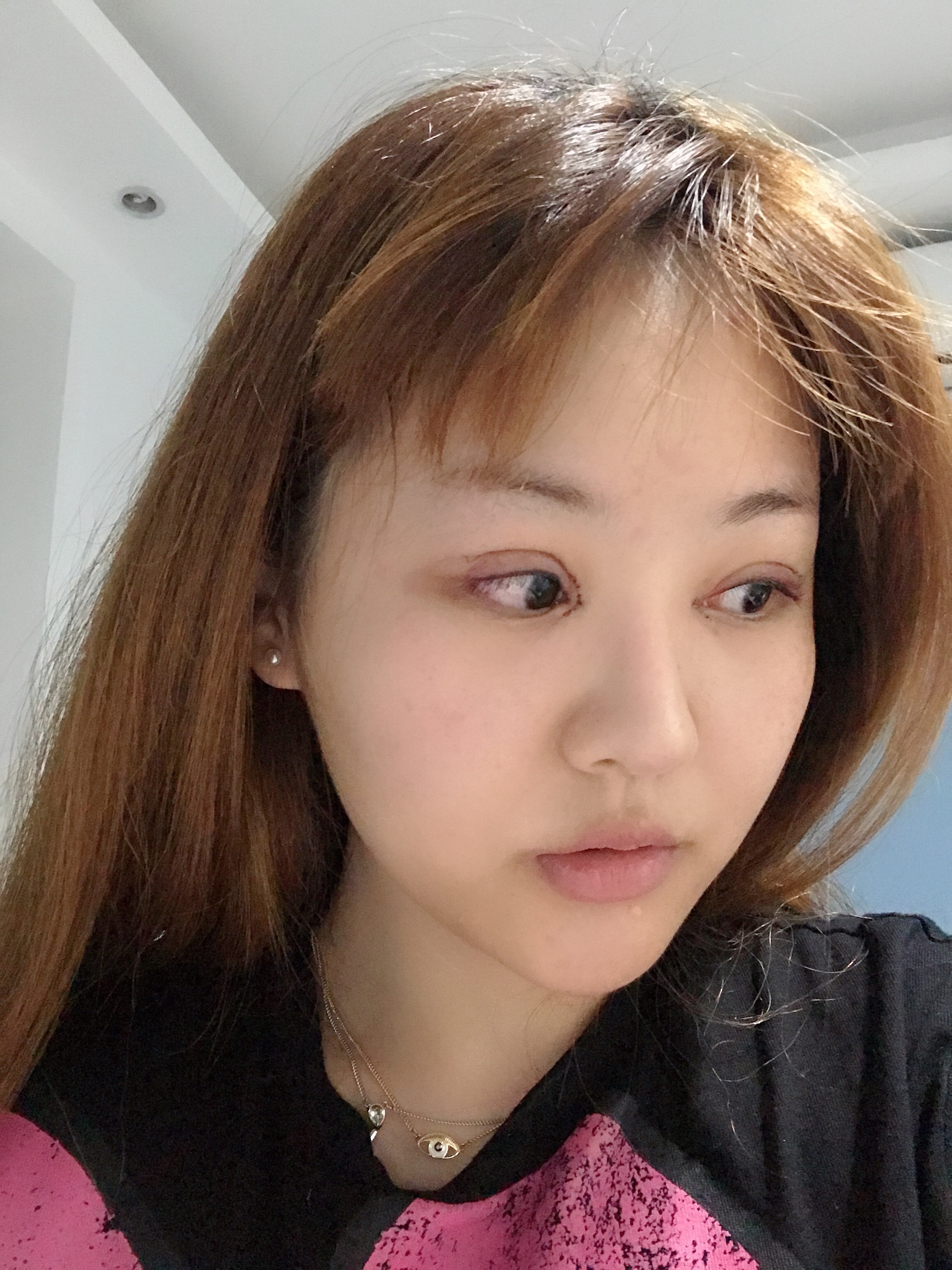 潘贰做双眼皮修复好不好?附案例