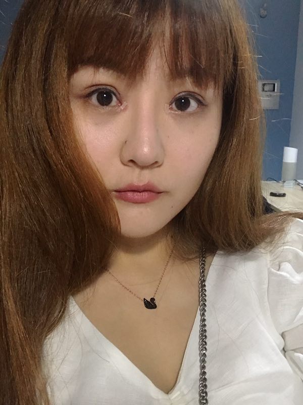 潘贰做双眼皮修复好不好?附案例