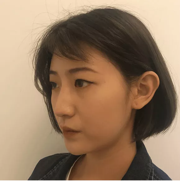 成都米兰柏羽高亮做双眼皮怎么样？附案例
