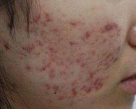 微针去痘印真的有效吗？