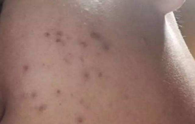 微针取痘印真的有效吗？